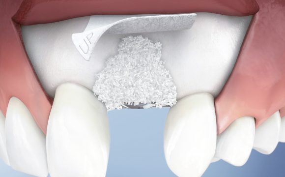 enxerto osseo 580x360 - Clínica Autran Odontologia